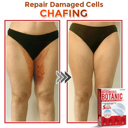 2025 SkinPrikyn™ MicroNeedle Botanic Skin Tag Removal Patch 🇺🇸 Made in the USA