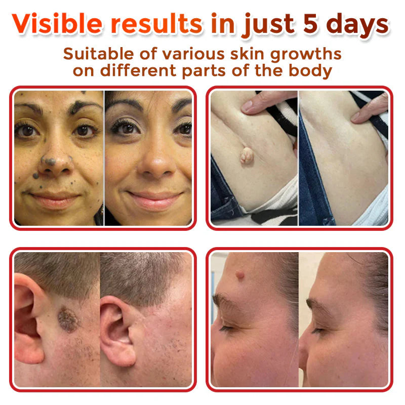 2025 SkinPrikyn™ MicroNeedle Botanic Skin Tag Removal Patch 🇺🇸 Made in the USA