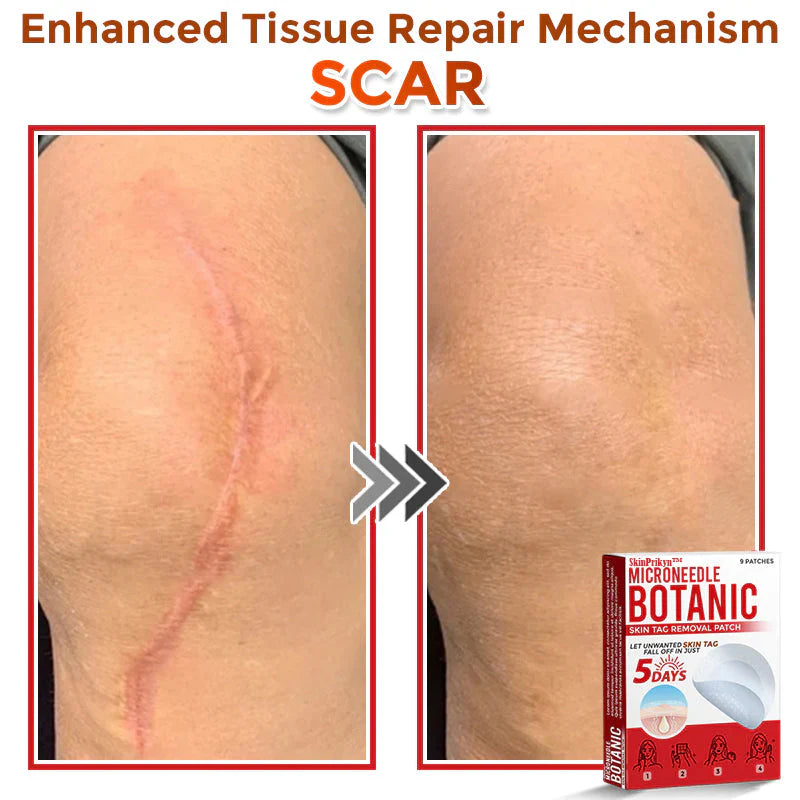2025 SkinPrikyn™ MicroNeedle Botanic Skin Tag Removal Patch 🇺🇸 Made in the USA