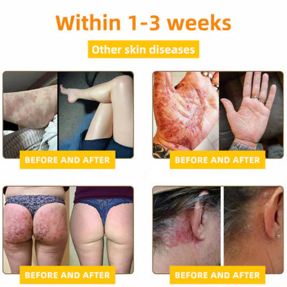 2025 LOVILDS™ Bee Toxin Skin Repair Cream(AAD Recommended👨‍⚕️)