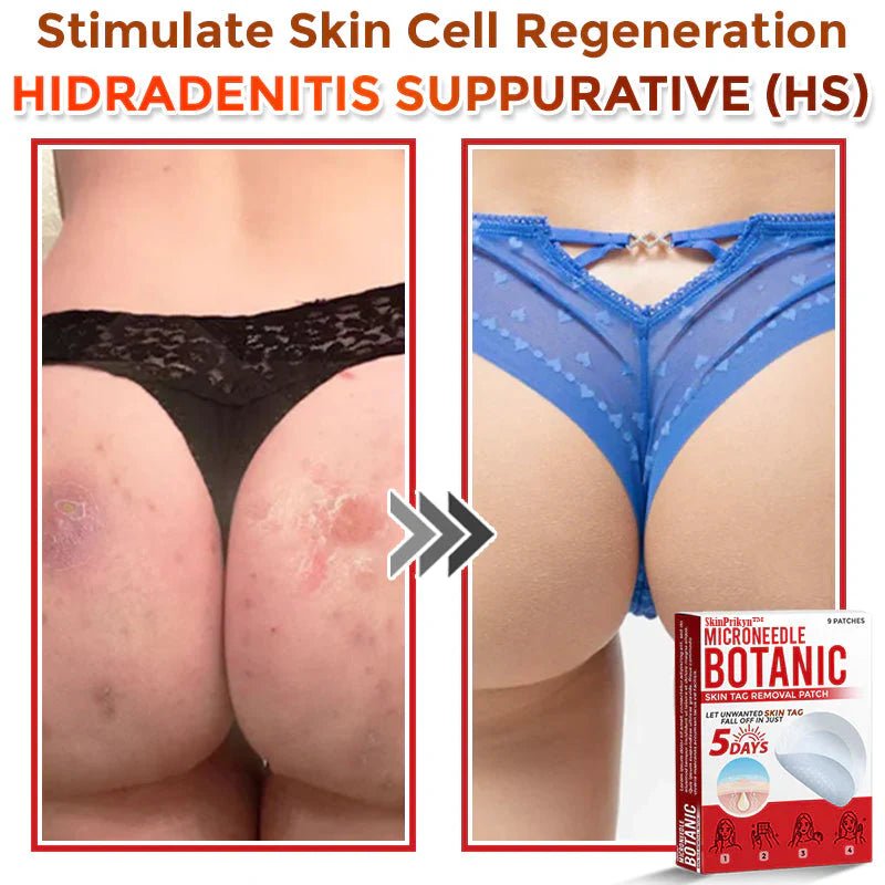 2025 SkinPrikyn™ MicroNeedle Botanic Skin Tag Removal Patch 🇺🇸 Made in the USA