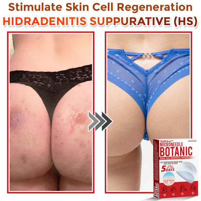 2025 SkinPrikyn™ MicroNeedle Botanic Skin Tag Removal Patch 🇺🇸 Made in the USA