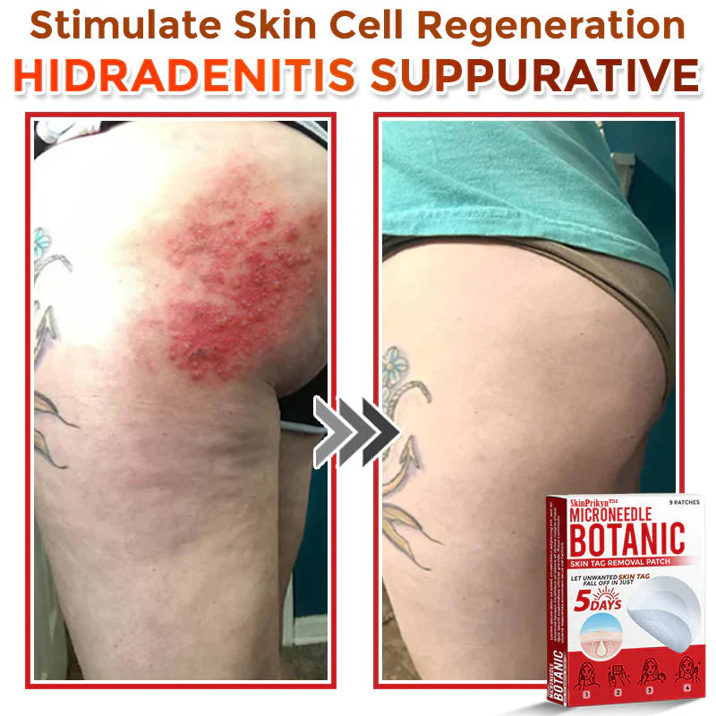 2025 SkinPrikyn™ MicroNeedle Botanic Skin Tag Removal Patch 🇺🇸 Made in the USA