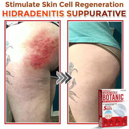2025 SkinPrikyn™ MicroNeedle Botanic Skin Tag Removal Patch 🇺🇸 Made in the USA